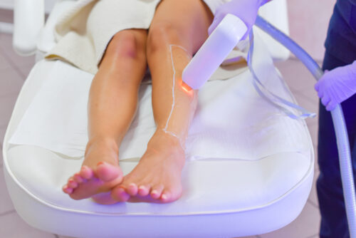 Nahaufnahme der Beine einer Frau, die auf einer Behandlungsliege liegt und eine Laser-Haarentfernung an den Unterschenkeln erhält. Das Lasergerät ist auf den Behandlungsbereich gerichtet und projiziert einen Lichtstrahl auf die Haut.