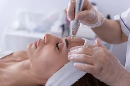 Frau erhält eine Microneedling-Gesichtsbehandlung mit speziellem Gerät durch eine Kosmetikerin mit Handschuhen