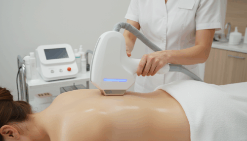 Laser Haar-Entfernung