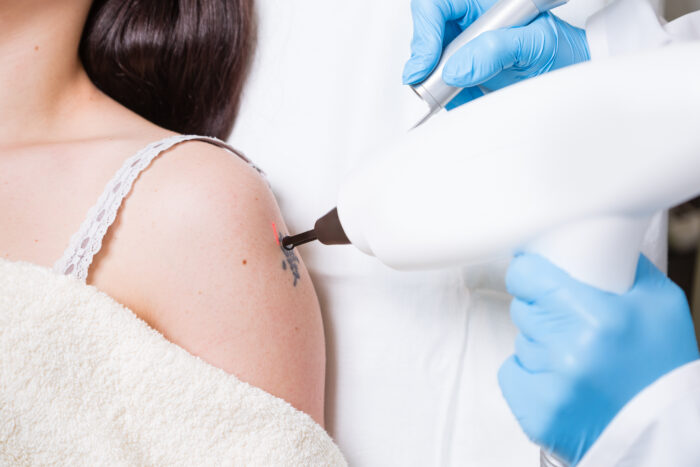 Entfernung von Permanent Make-up und Tattoos – Bild 2