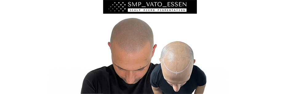 Vorher-Nachher-Vergleich einer Haarpigmentierung im oberen Kopfbereich bei SMP Vato Essen