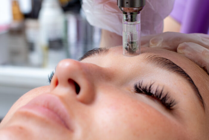 Microneedling – Bild 3