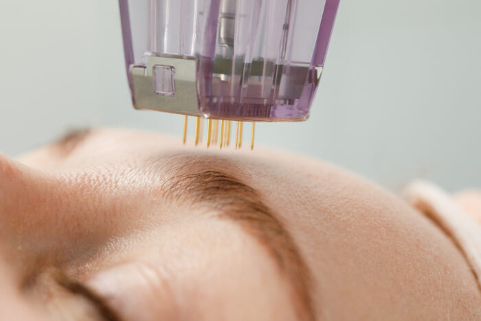 Microneedling – Bild 2