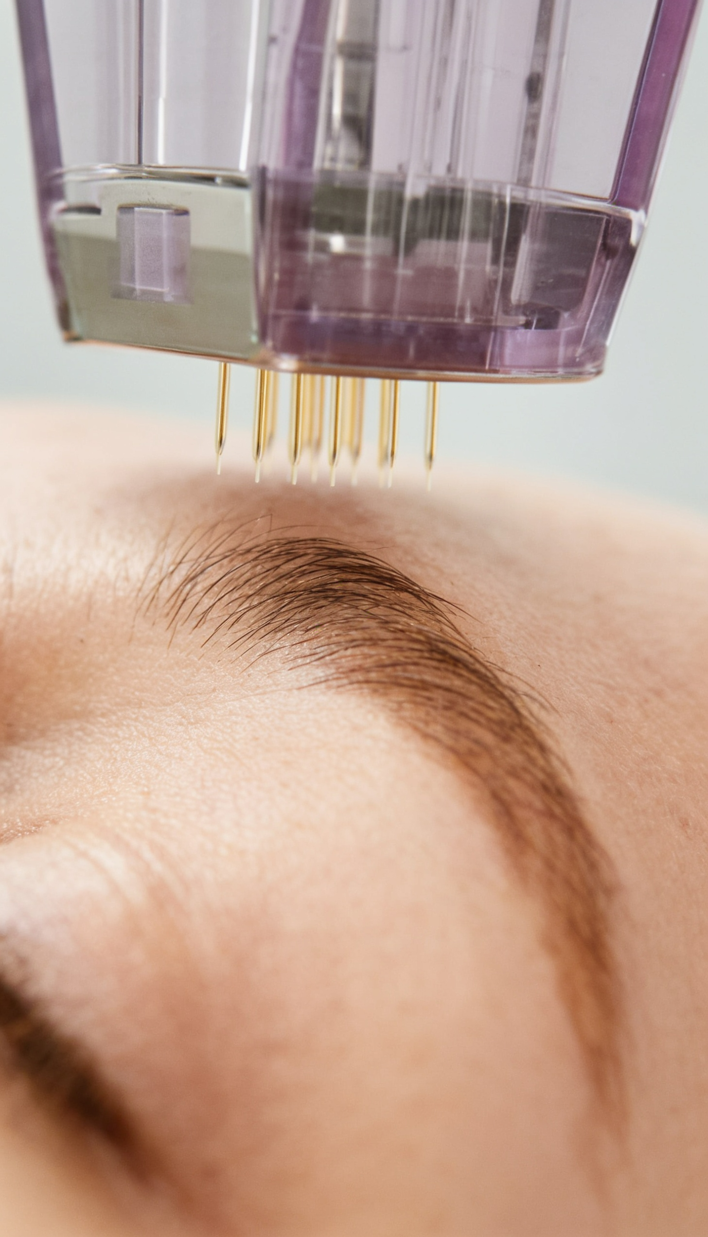 Microneedling – Bild 3