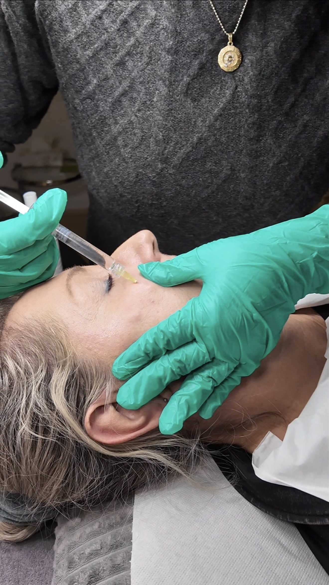 Mesotherapie mit Hyaluron – Bild 3