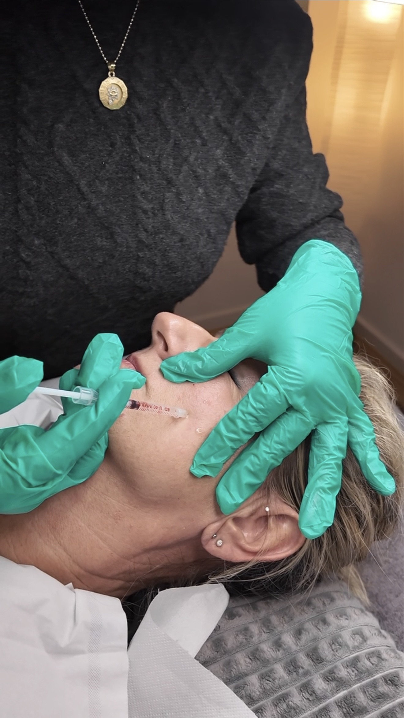 Mesotherapie mit Hyaluron – Bild 4