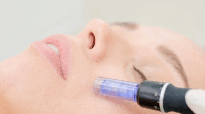 60 Min. Microneedling – Bild 2