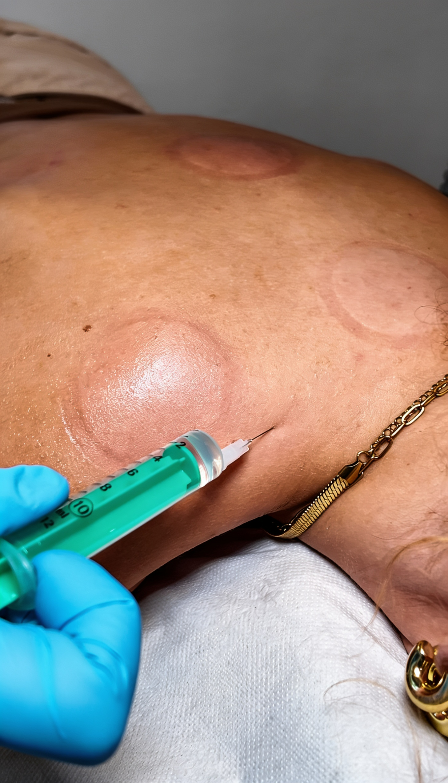 Neuraltherapie bei Naturo Medicus Gelsenkirchen im Rahmen der Akutschmerz Intensivbehandlung – gezielte Injektion zur Schmerzbehandlung im Schulterbereich