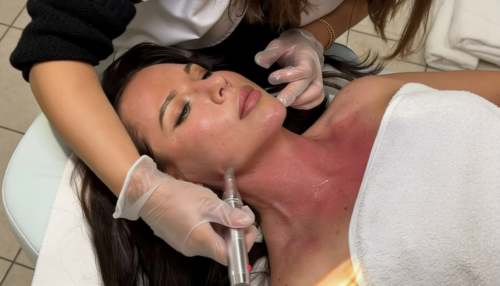 Microneedling Behandlung