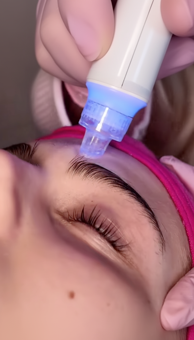 Aquafacial & Microneedling – Bild 4