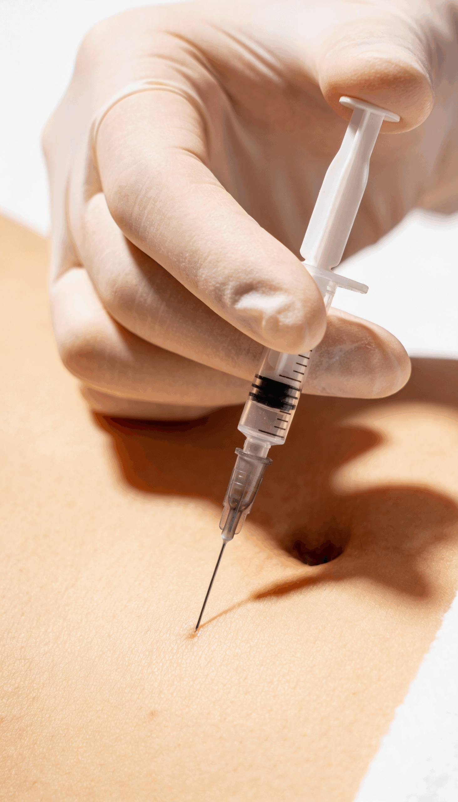 Injektionslipolyse an 1 Zone – Bild 4