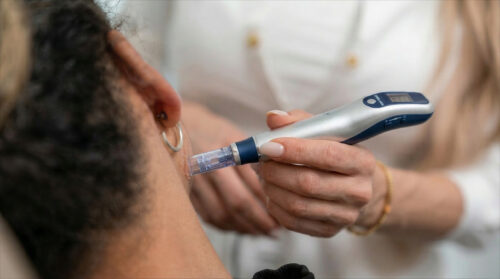 Medizinisches Microneedling