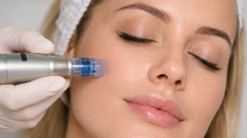 Microneedling