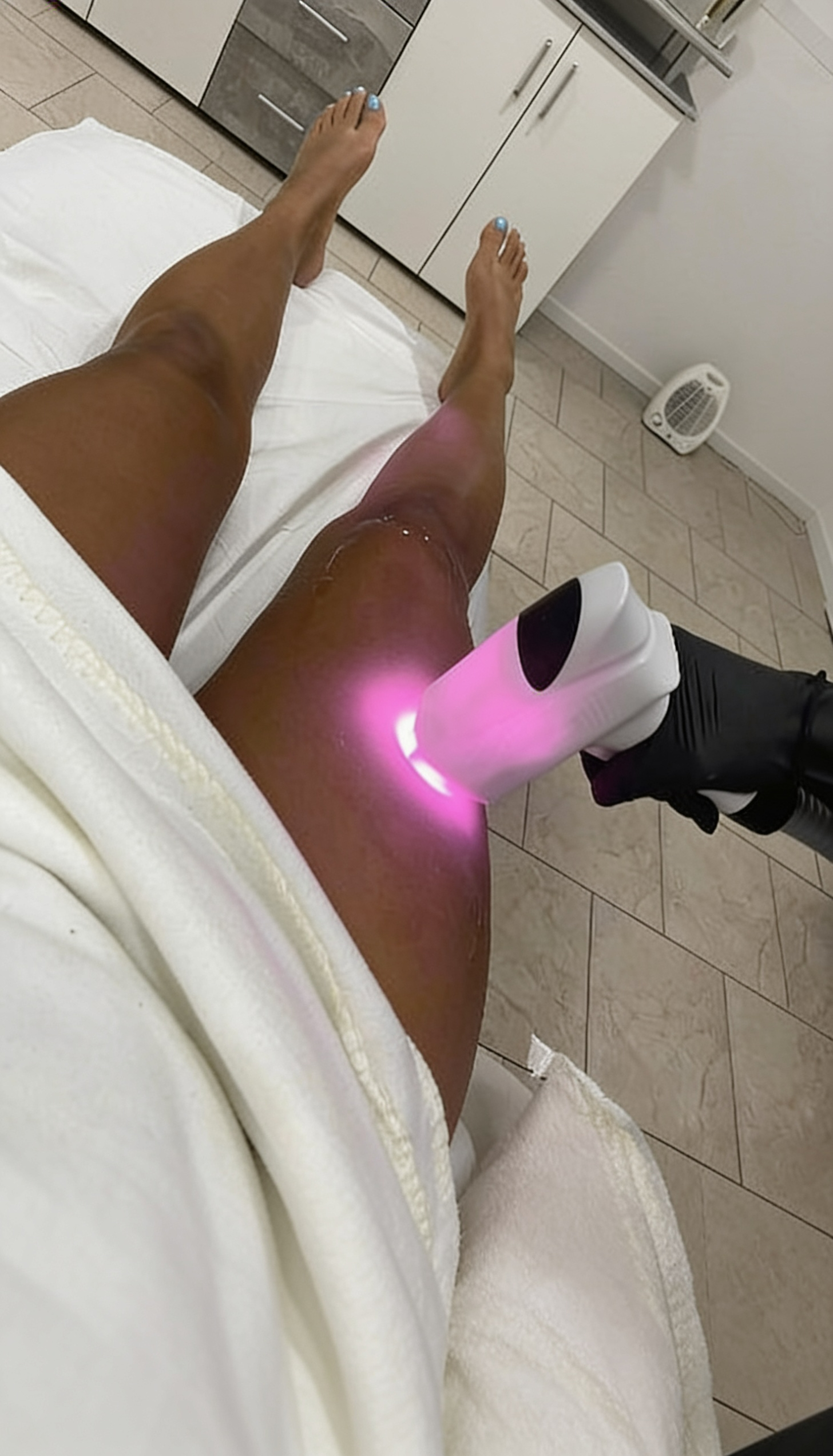 Dioden-Laser Haarentfernung – Bild 3