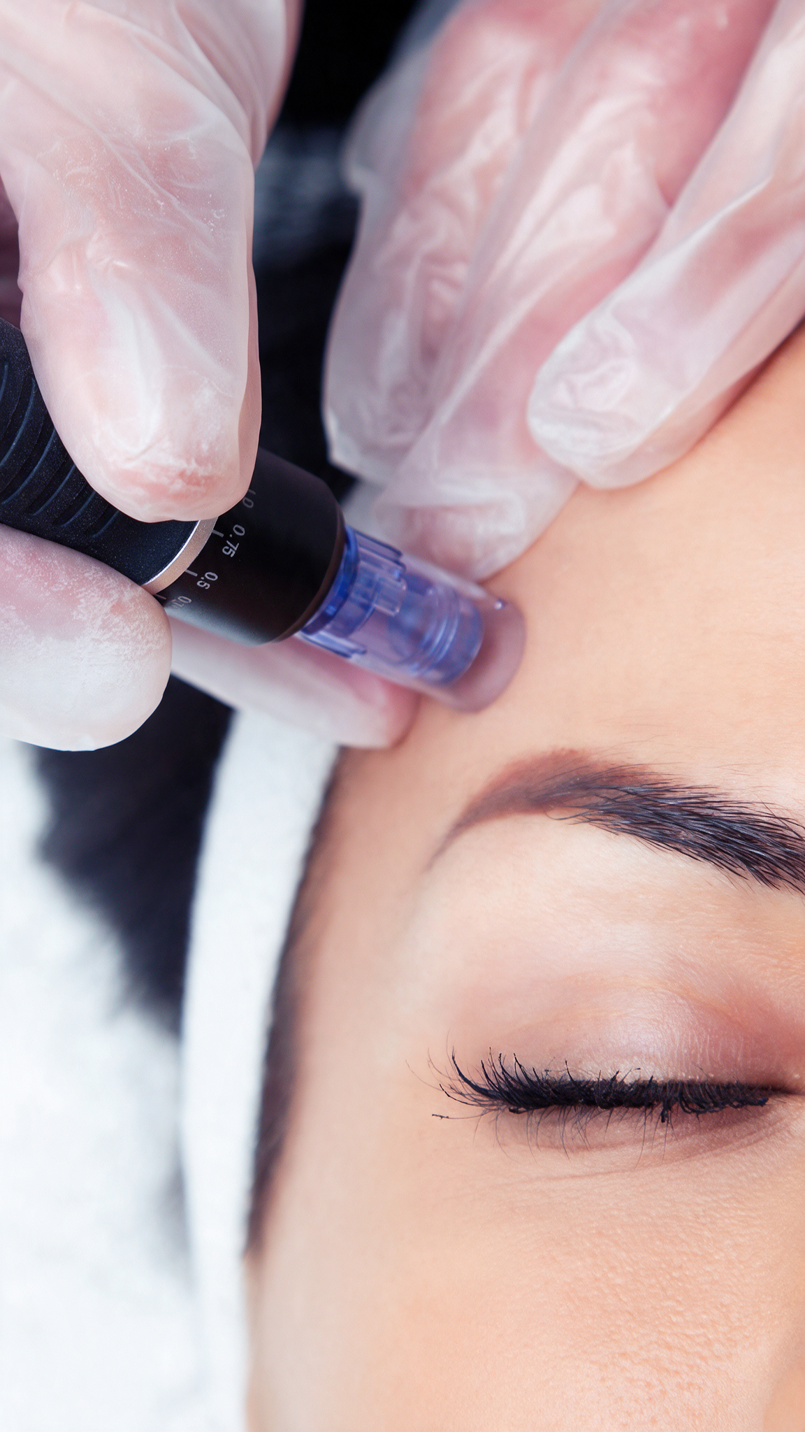 Aquafacial & Microneedling – Bild 3